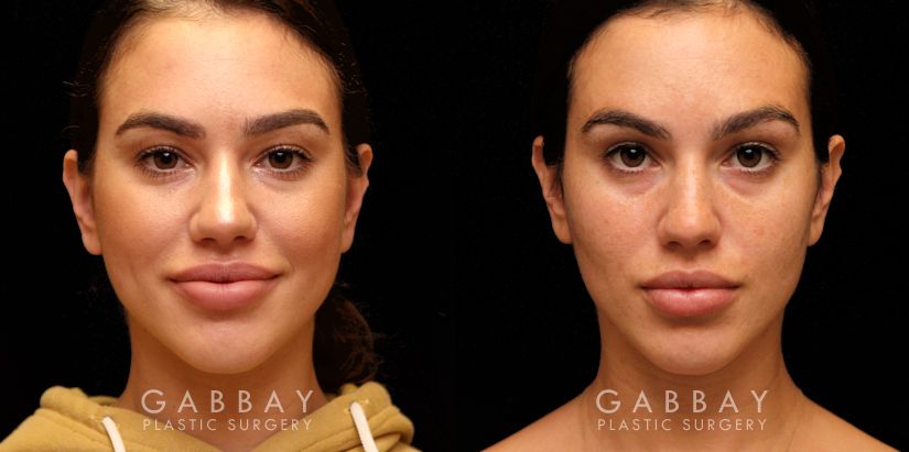 cheek fat removal cheek fat removal