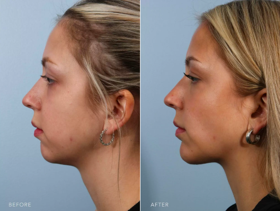 cheek fat removal cheek fat removal