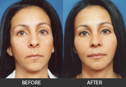 cheek implants