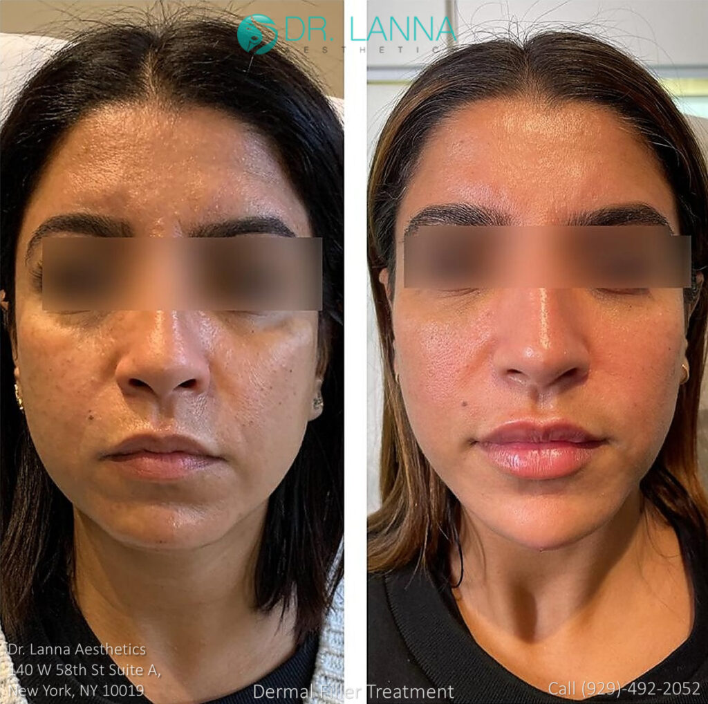 cheek implants