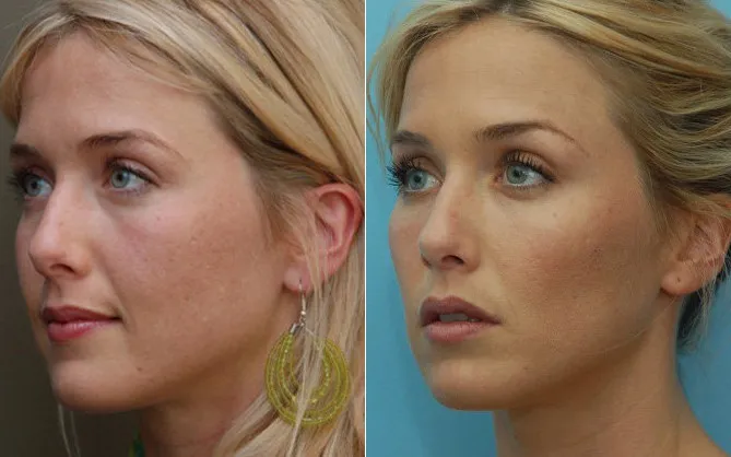 Cheek implants: Defining your features with precision