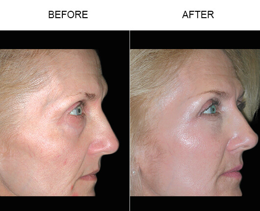 cheek lift cost cheek lift cost