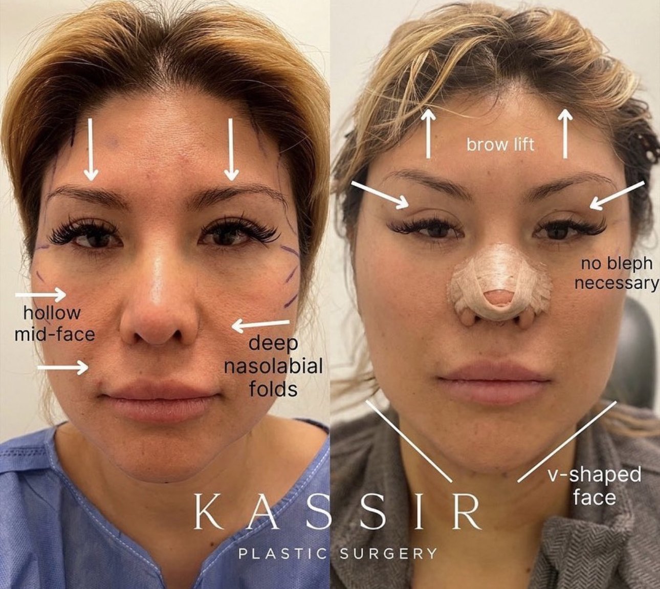 cheek lift cost cheek lift cost
