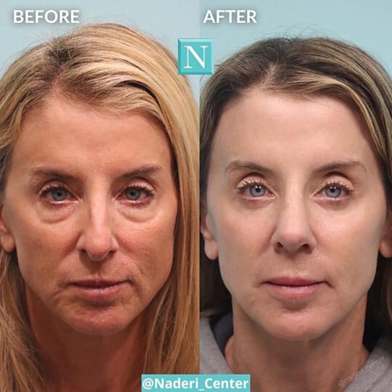 Cheek lift cost: What affects the price of mid-face rejuvenation