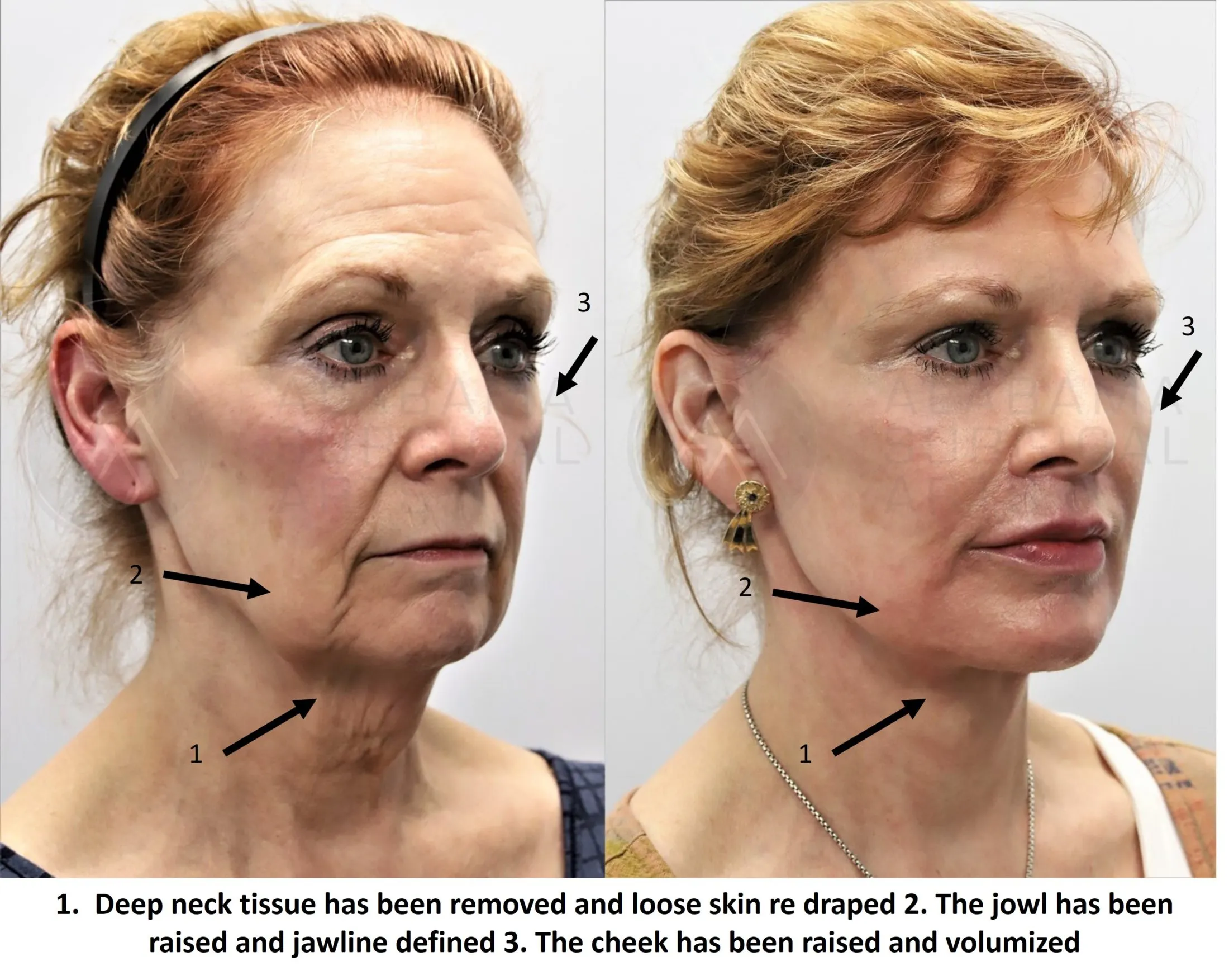cheek lift cost cheek lift cost