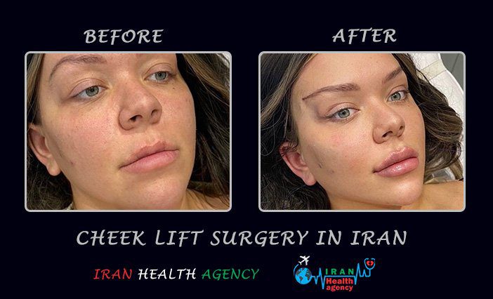 cheek lift cheek lift