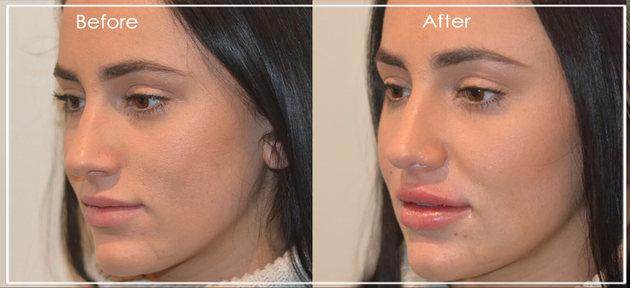 cheek lift cheek lift