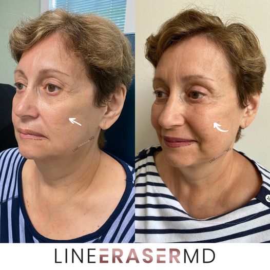 cheek lift cheek lift