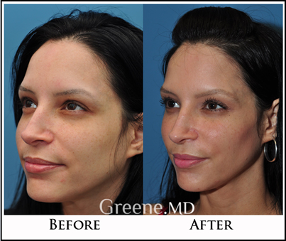 Cheek lift: Defining your face with targeted enhancements