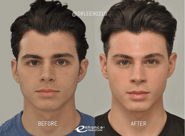 cheek surgery cheek surgery