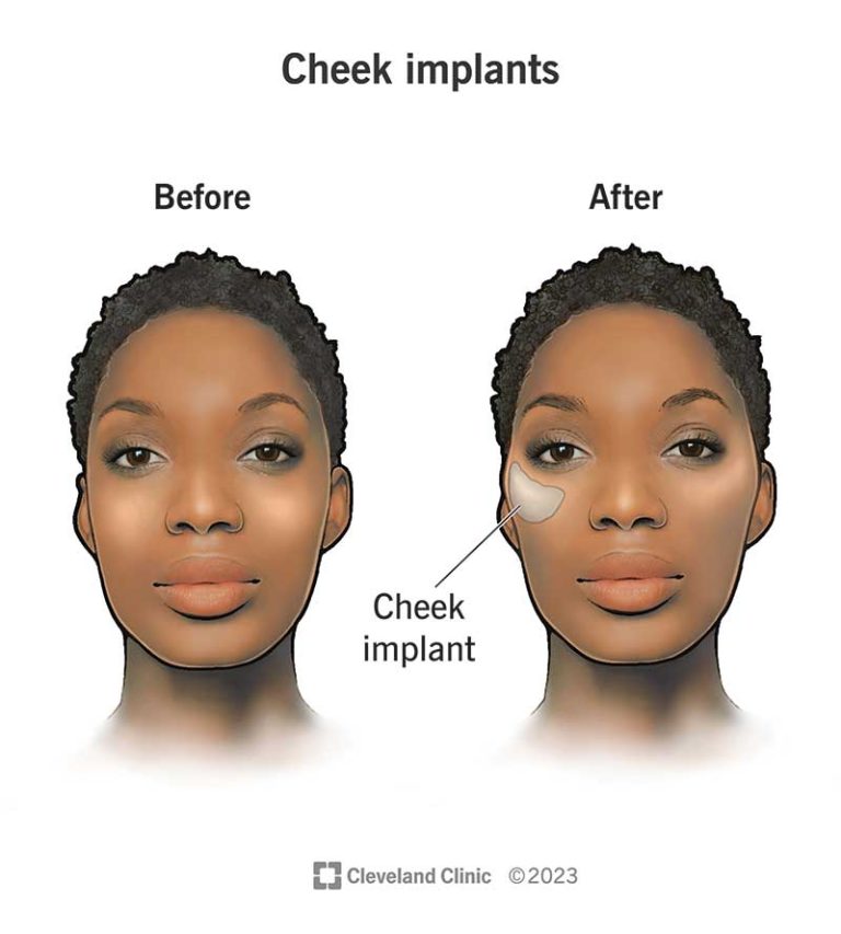 Cheekbone implants: Achieving high, sculpted cheekbones