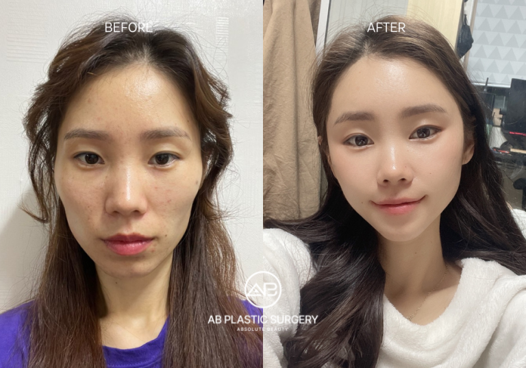Cheekbone reduction: Achieving balanced facial proportions