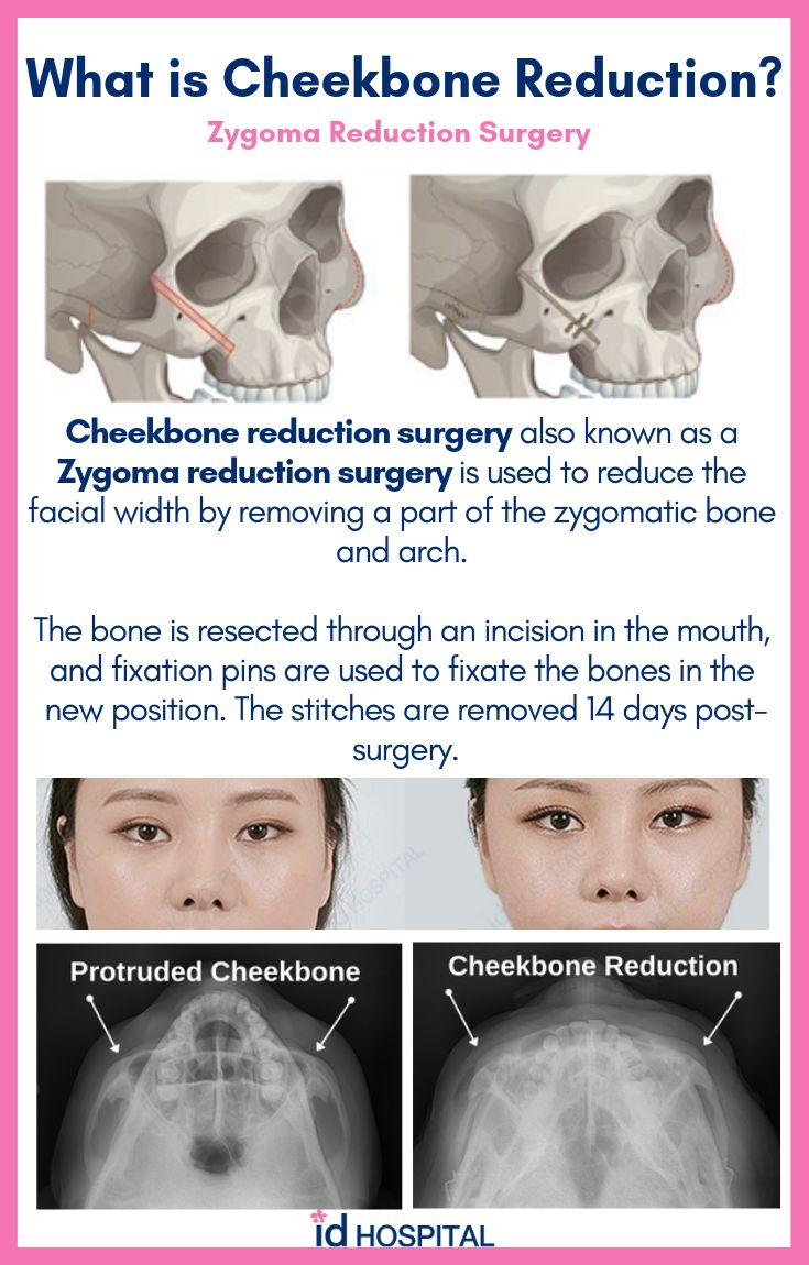 cheekbone reduction cheekbone reduction