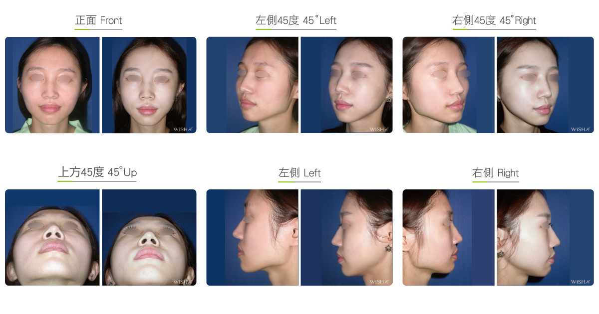 cheekbone surgery cheekbone surgery