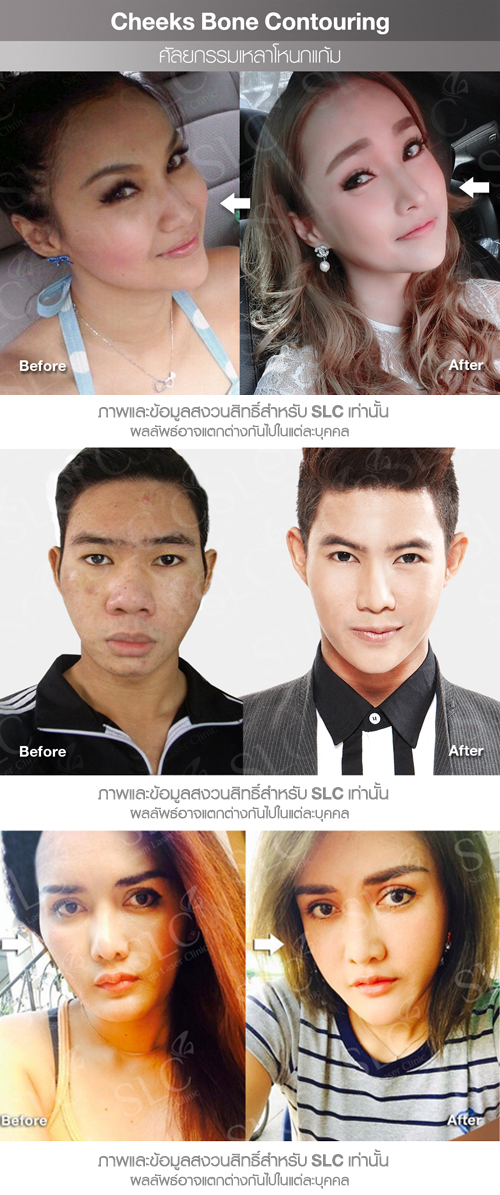cheekbone surgery cheekbone surgery