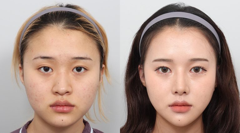 Cheekbone surgery: Defining your facial structure