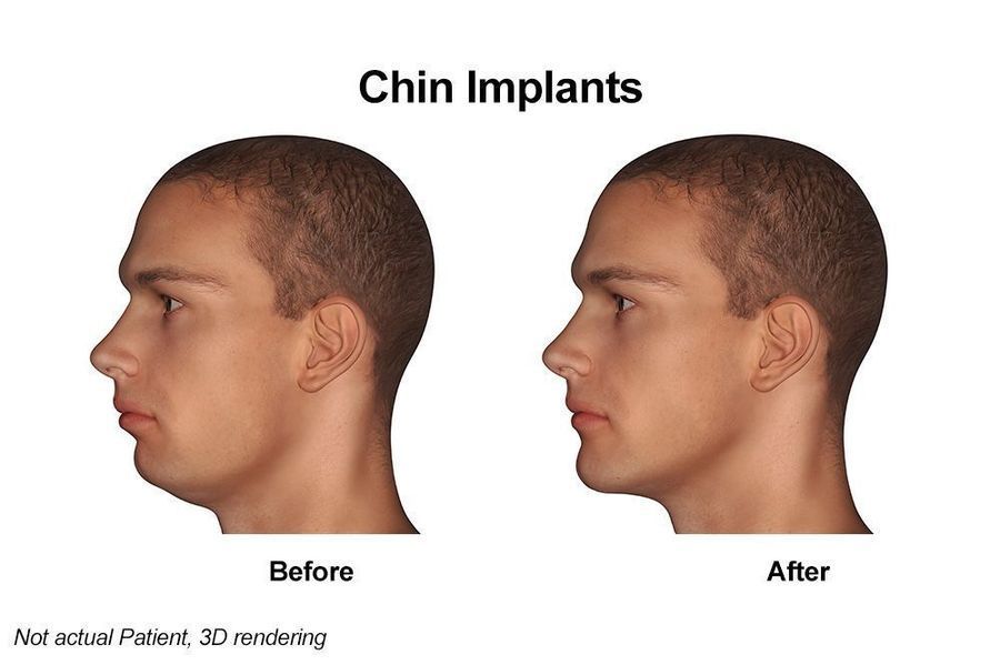 chin augmentation chin augmentation