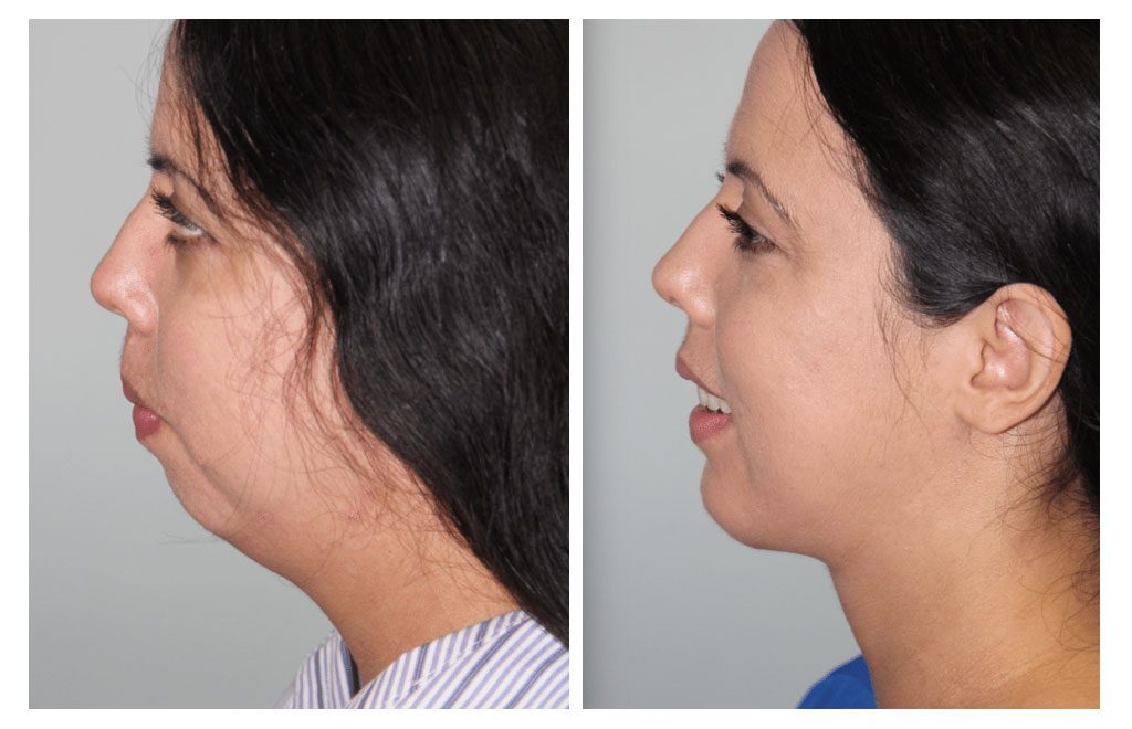 chin augmentation chin augmentation