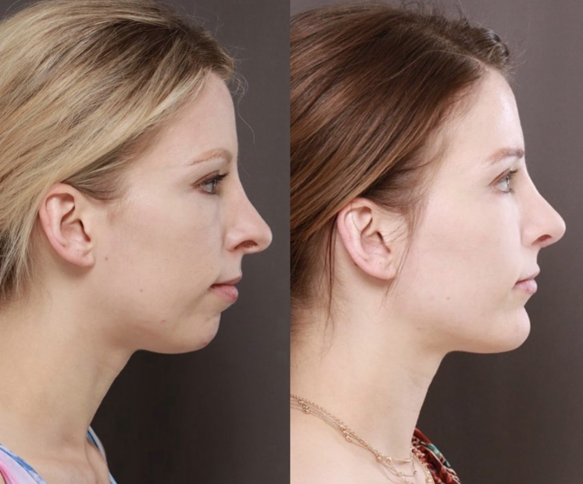 chin augmentation chin augmentation
