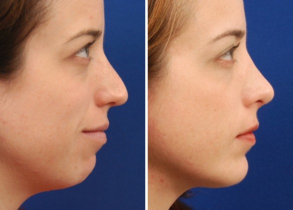 Chin augmentation: Boosting your profile with precision