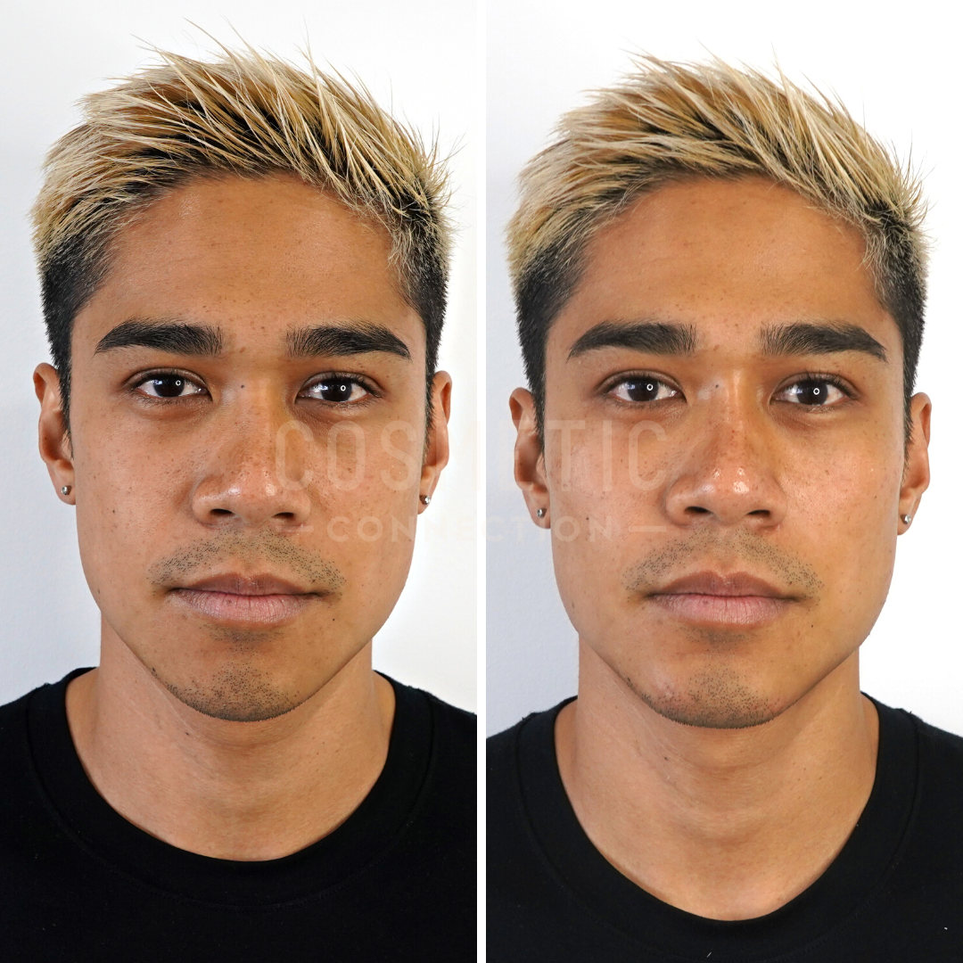 chin augmentation chin augmentation