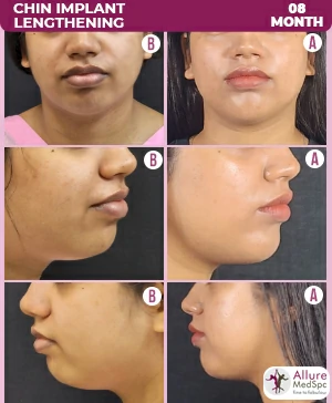 chin augmentation cost chin augmentation cost