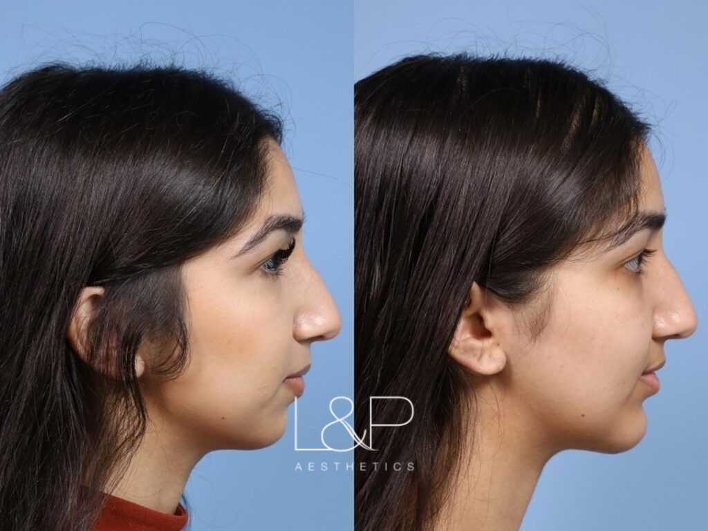 chin enhancement chin enhancement