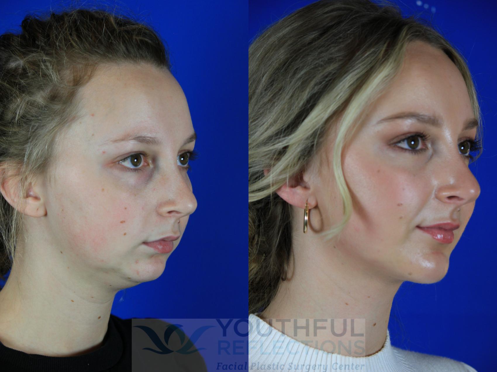 chin enhancement chin enhancement