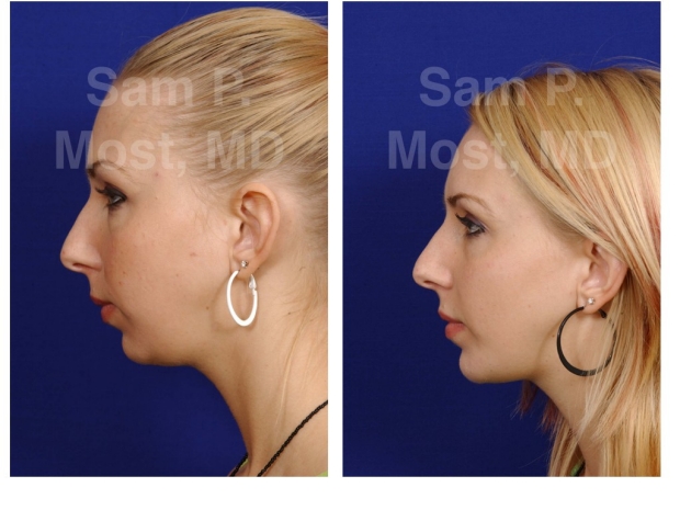chin enhancement chin enhancement