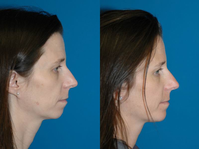 chin implant cost