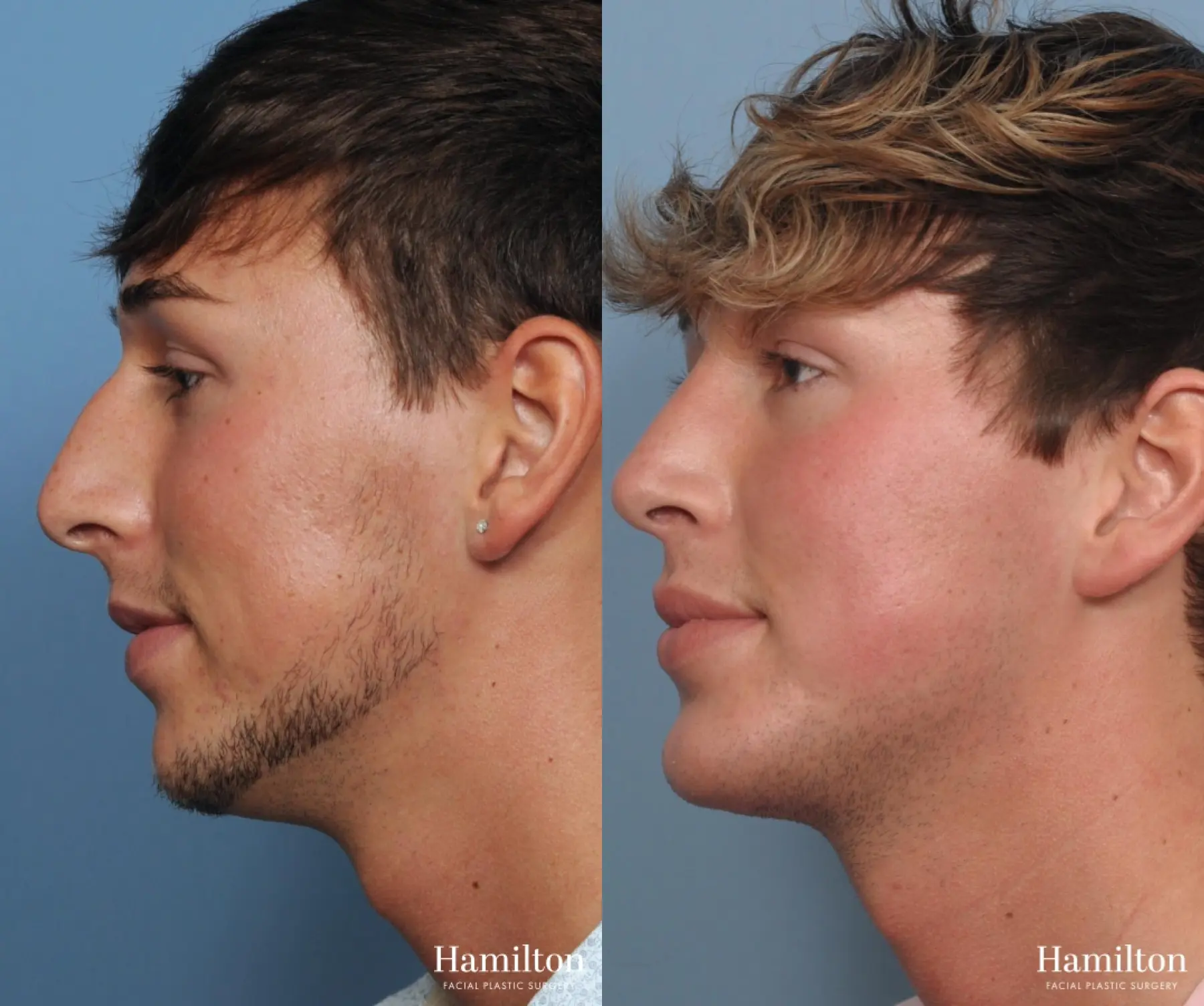 chin implant cost