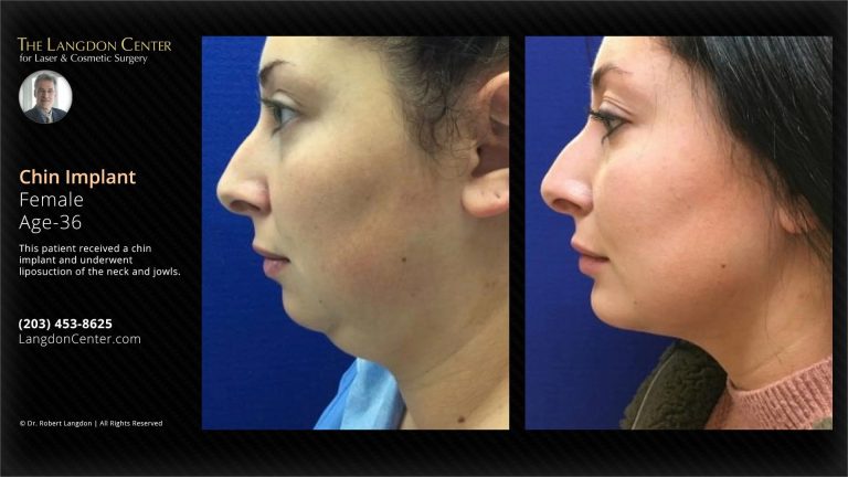 Chin implant cost: What to budget for enhanced features