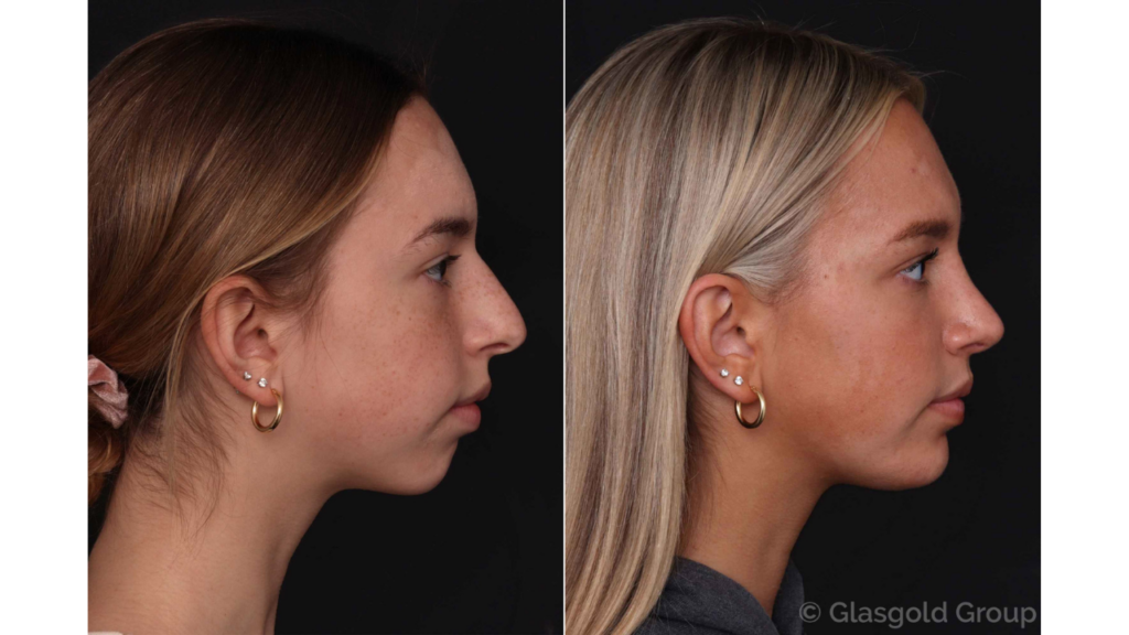 chin implant cost