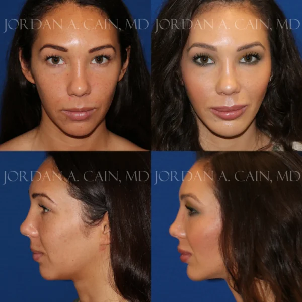 chin implant cost