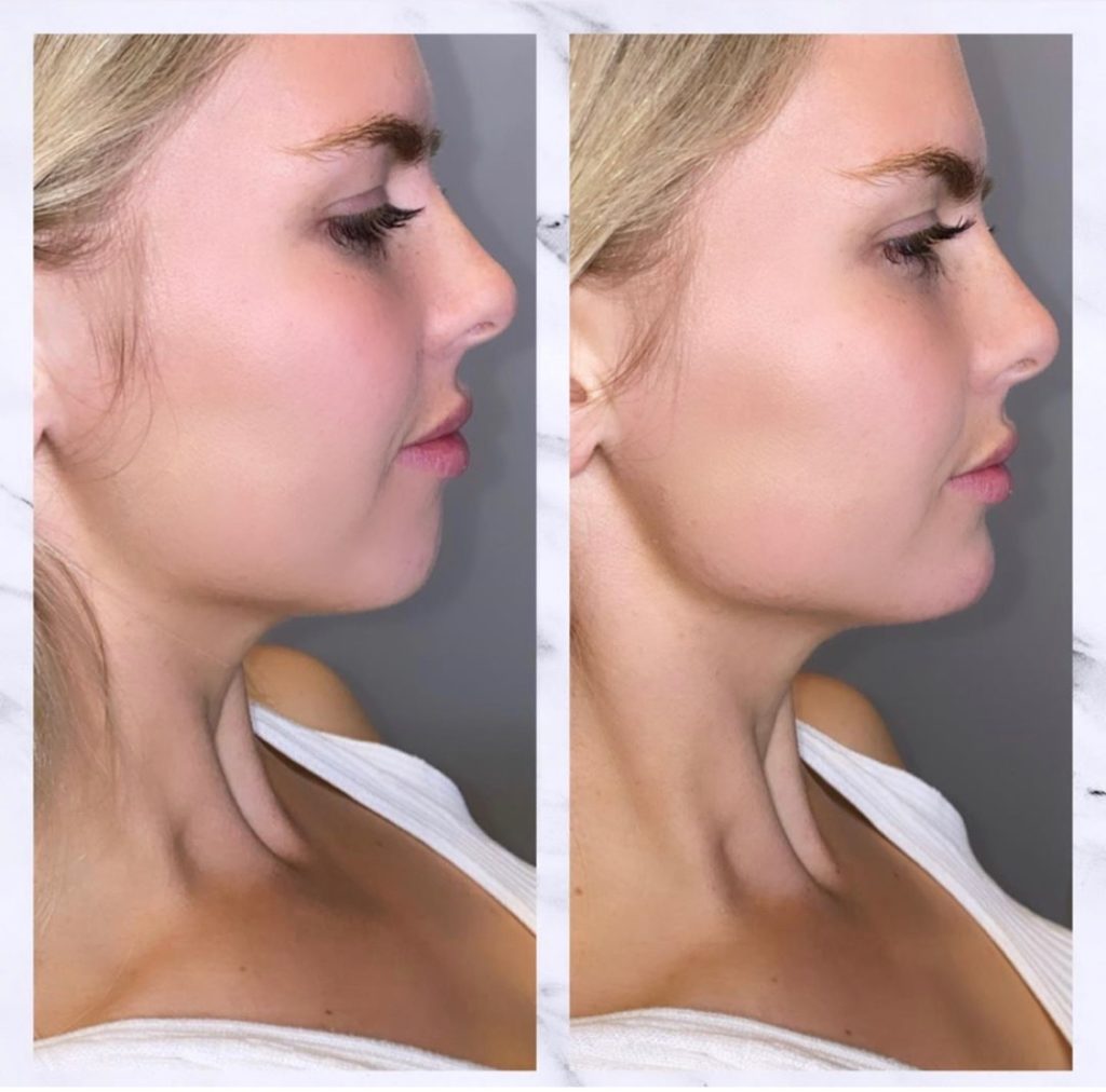 chin injection