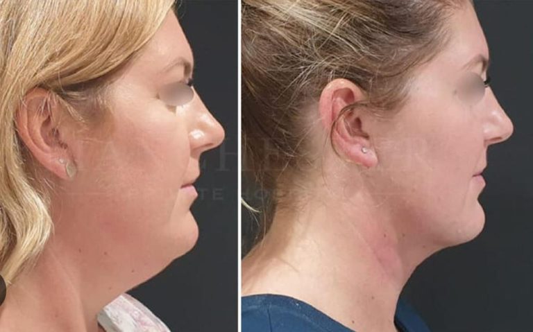 chin lift surgery chin lift surgery