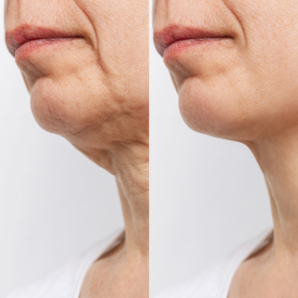 chin lift surgery chin lift surgery