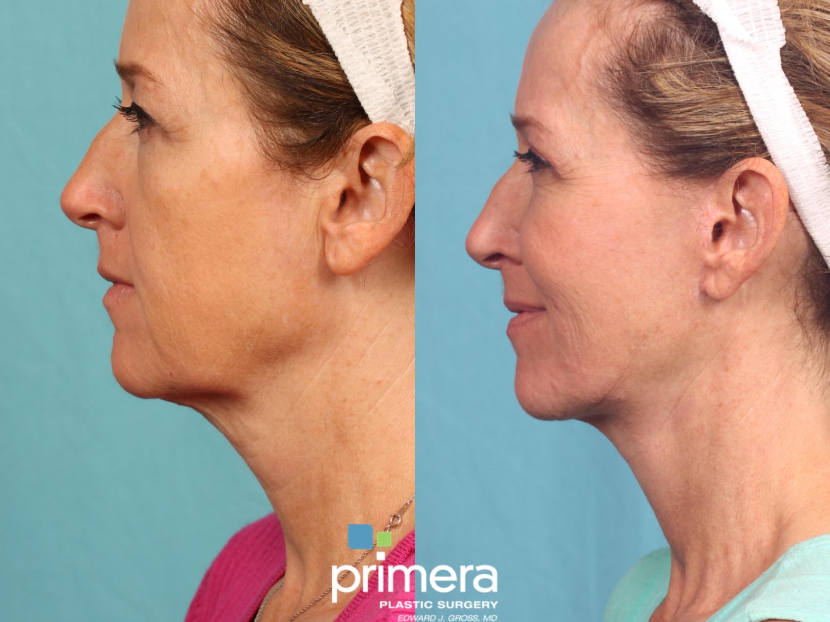 chin lift surgery chin lift surgery