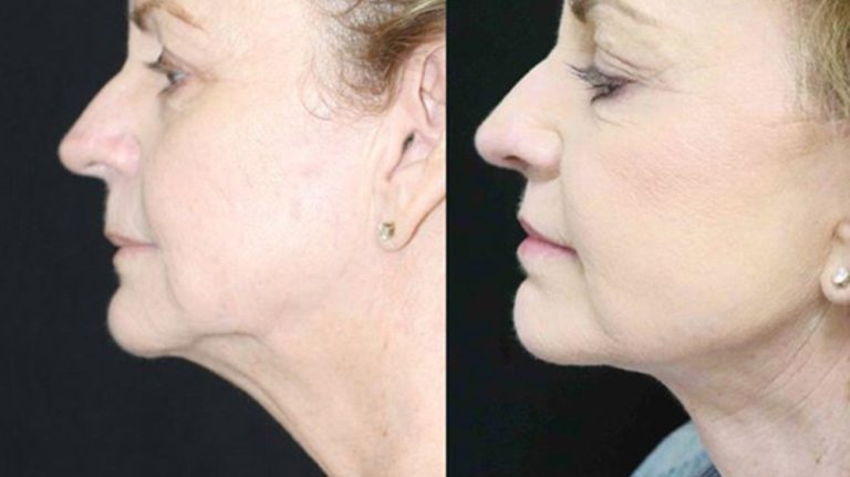 Chin lift surgery: Achieving a slimmer, defined jawline