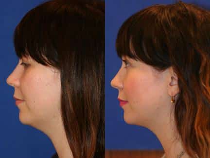 chin lifts chin lifts