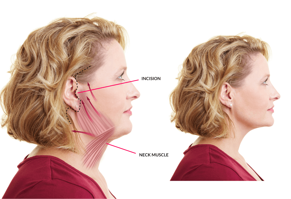 chin lifts chin lifts