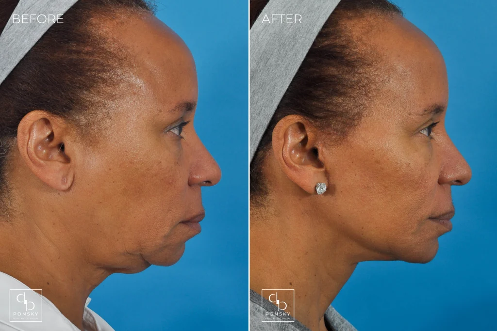 chin lifts chin lifts