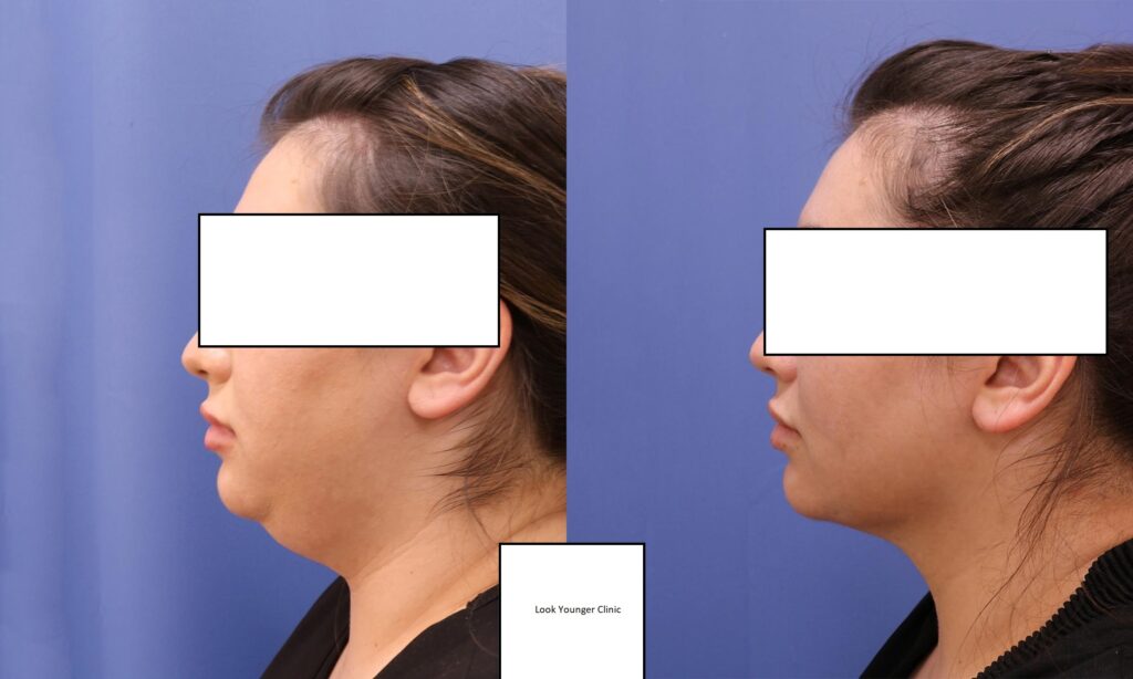 chin lipo cost