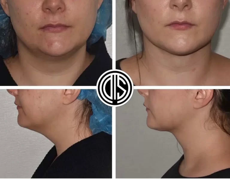 Chin Lipo Cost: Slimming and defining the chin