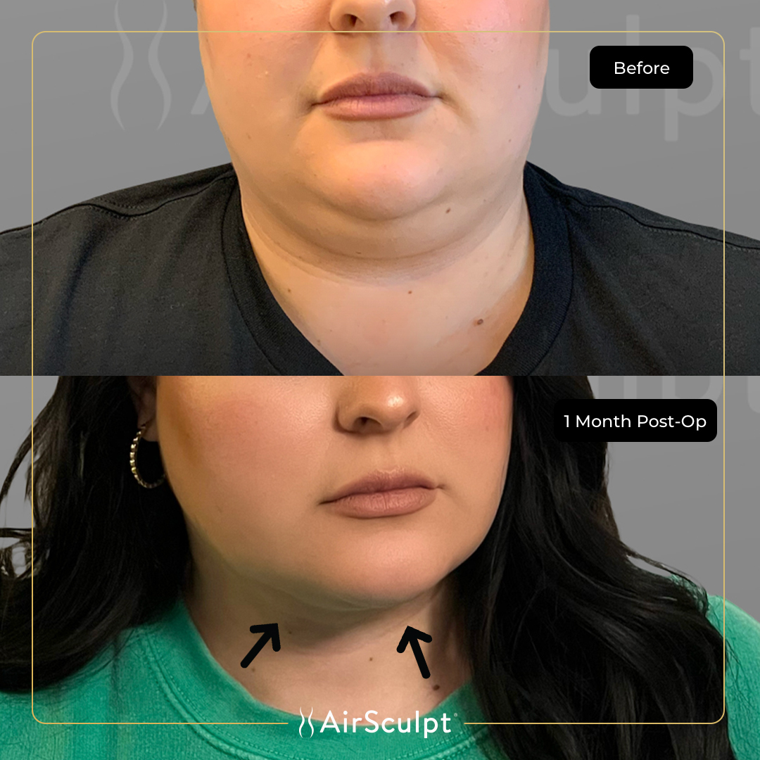 chin lipo cost