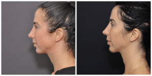 Chin Lipo: Streamlined and defined