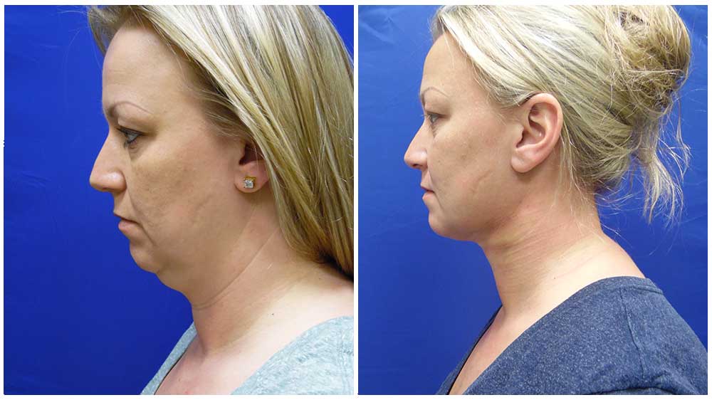 chin lipo