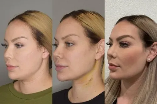 chin lipo