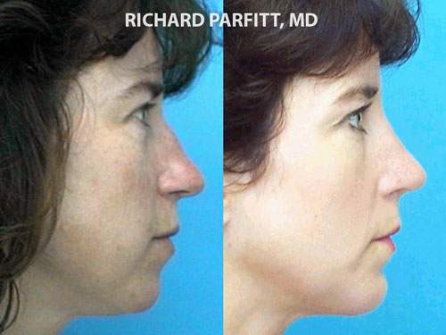 chin plastic surgery chin plastic surgery