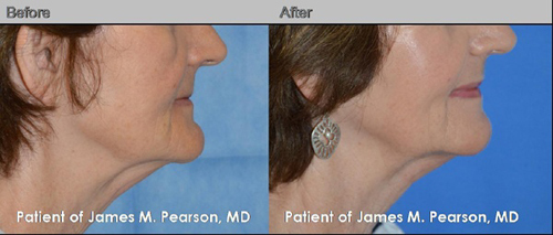 Chin plastic surgery: A guide to reshaping your jawline